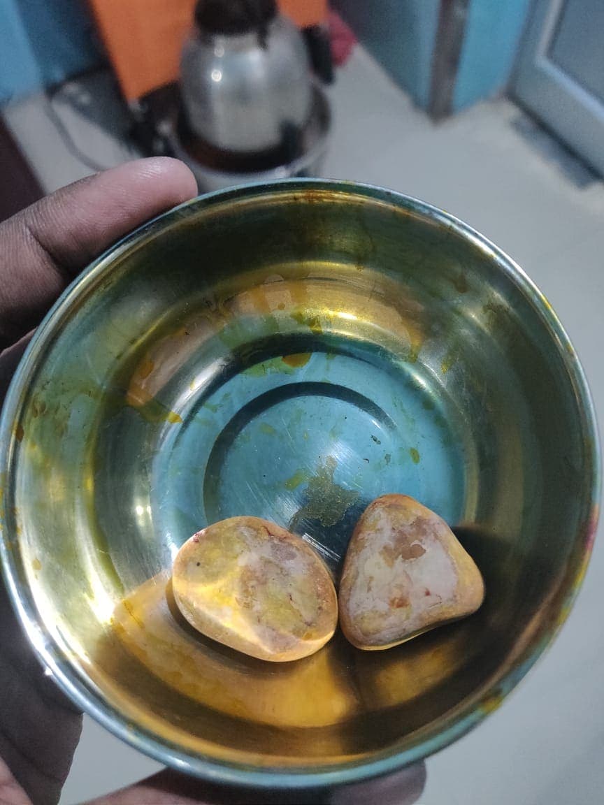 Two large stones from urinary bladder.jpeg
