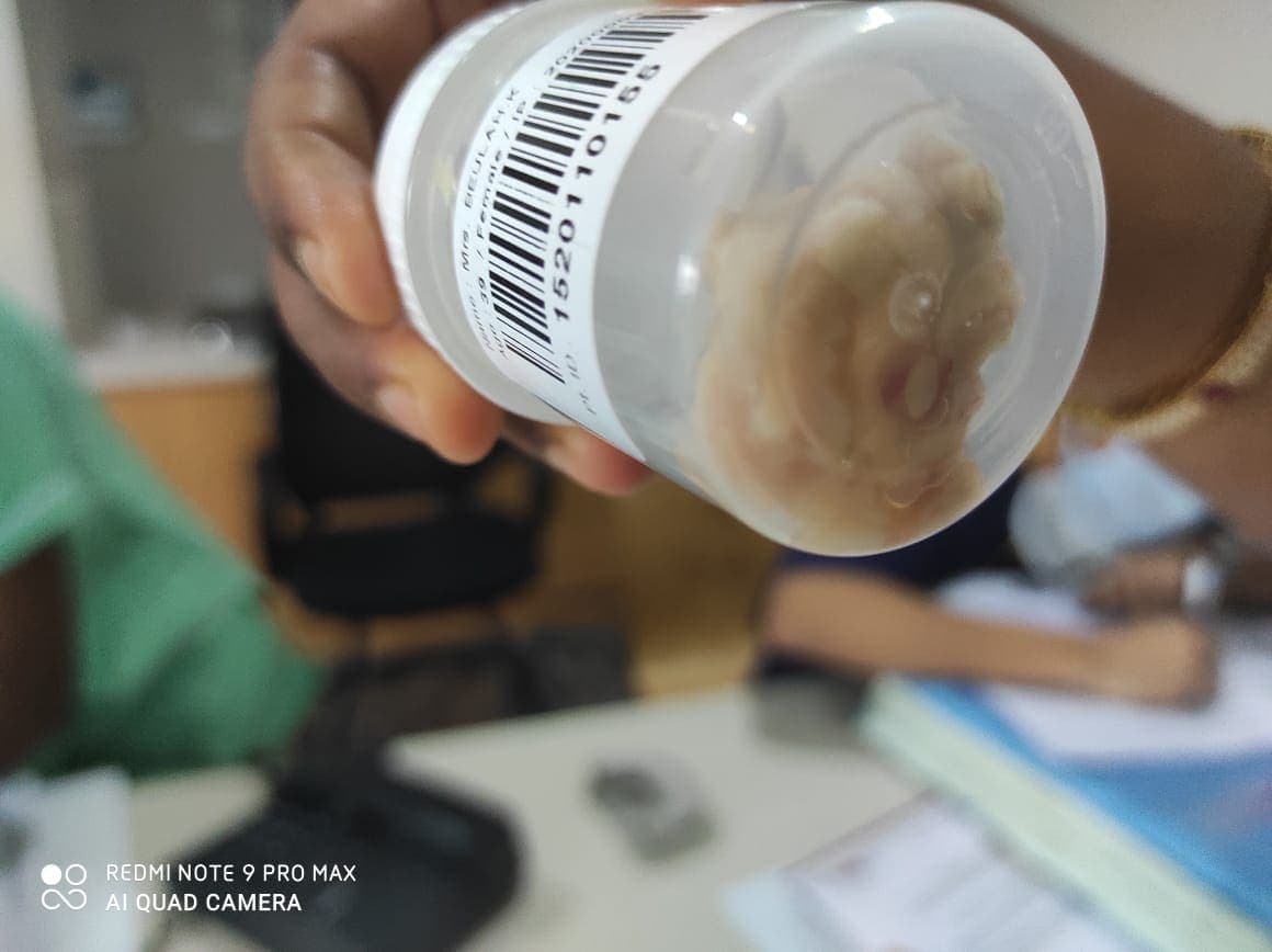 Pus which was removed.jpeg